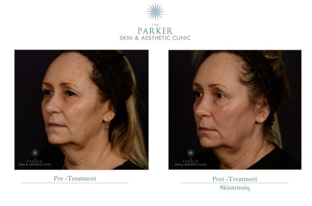 Obagi Skintrinsiq Before and After photo. clinically proven skincare.