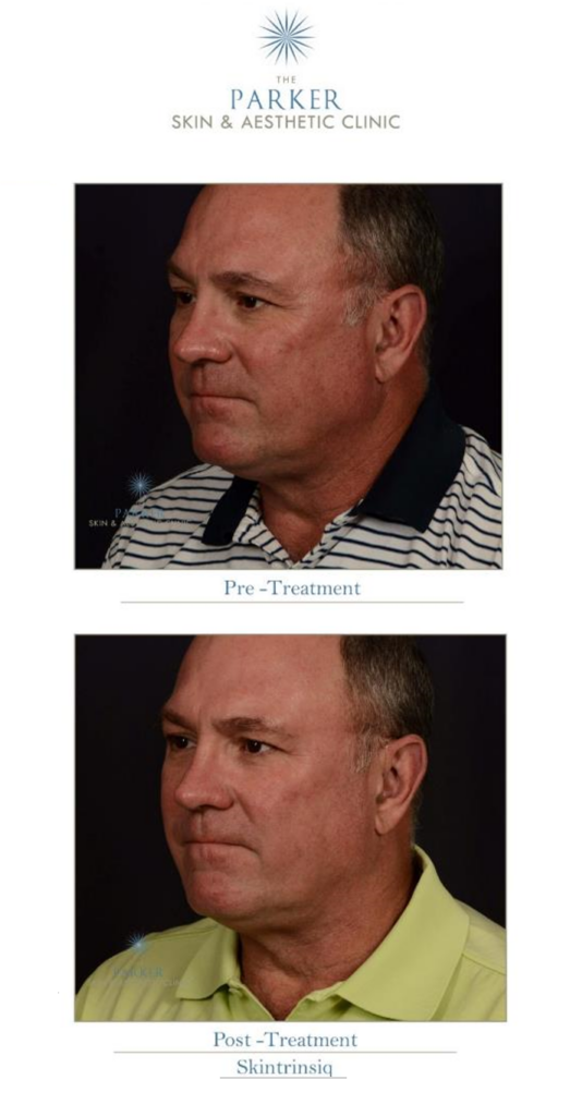 Before and After results photo from Skinrinsiq in combination with Obagi Medical skincare products. Male Men Skincare.