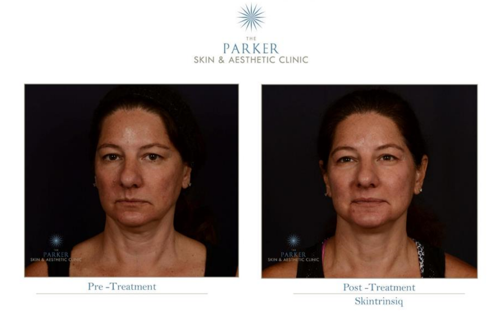 Obagi Skintrinsiq Before and After photo. clinically proven skincare.